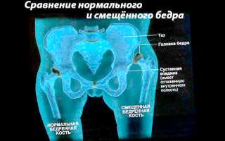 Врожденный вывих бедра — как лечить дисплазию у детей