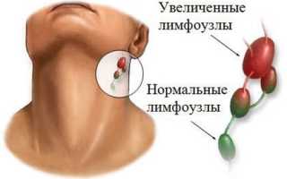 Симптомы, диагностика и профилактика цитомегаловируса