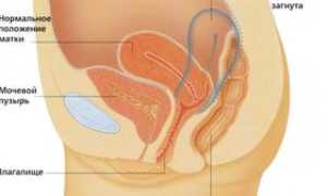 Опущение матки: причины, симптомы патологии и лечение
