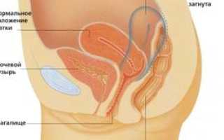 Опущение матки: причины, симптомы патологии и лечение