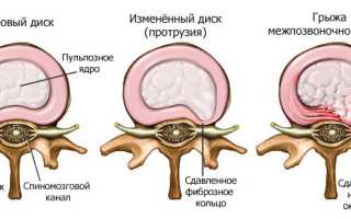 Грыжа шейного отдела позвоночника: симптомы, лечение и способы профилактики
