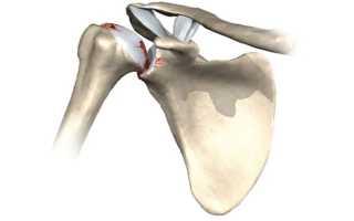 Чем лечить хондроз плечевого сустава — эффективные способы