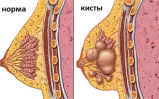 Особенности диффузного фиброаденоматоза молочной железы