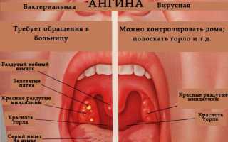 Алкоголь при ангине – прямая дорога к осложнениям