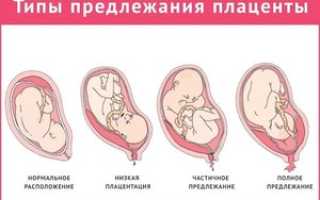 Низкая плацентация при беременности: причины, признаки, лечение