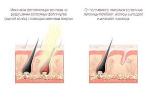 Что лучше: фотоэпиляция или лазерная эпиляция