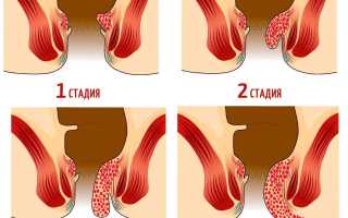 Как связаны геморрой и алкоголь?