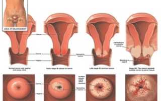 Эрозия шейки матки у нерожавших женщин: причины и лечение