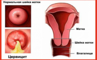 Признаки, диагноз и лечение маточной шейки при цервиците