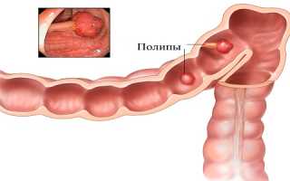 Полипы в прямой кишке: причины и лечение