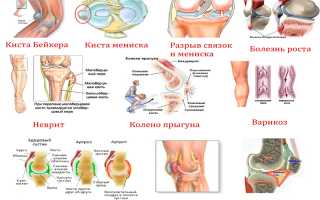 Что делать, если болят колени при приседании и вставании — эффективные методы лечения