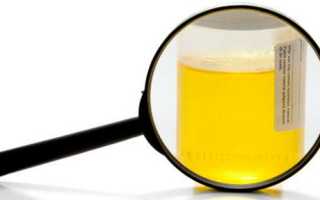 Ярко-желтая моча после приема витаминов, причины изменения цвета