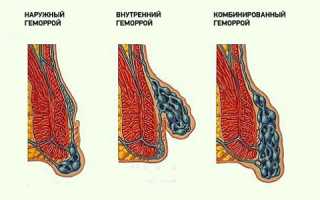 Какие существуют признаки геморроя у мужчин?