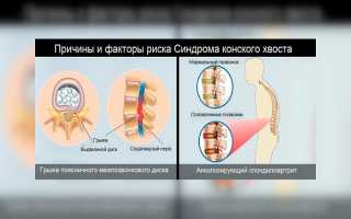 Что такое синдром конского хвоста — эффективные методы лечения