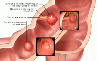 Симптомы и лечение полипов прямой кишки