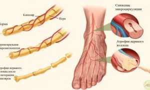 Полинейропатия нижних конечностей: лечение и восстановление