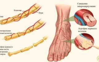 Полинейропатия нижних конечностей: лечение и восстановление