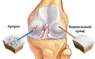 Все, что нужно знать про артроз суставов