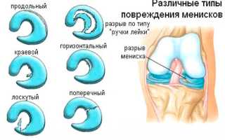Функции мениска коленного сустава — как уберечься от повреждений хрящевой прослойки