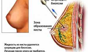 Киста молочной железы: причины, симптомы, лечение