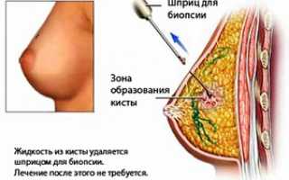 Киста молочной железы: причины, симптомы, лечение