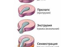 Секвестрированная грыжа позвоночника. Насколько опасна патология?