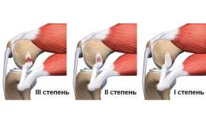 Основные причины разрыва связок плечевого сустава — оказание доврачебной помощи