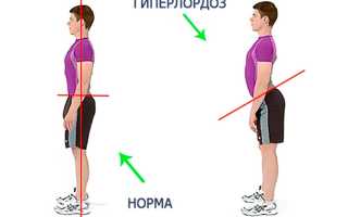 Что такое гиперлордоз поясничного отдела