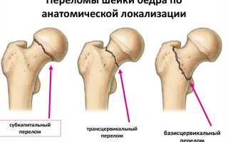 Боль в тазобедренном суставе