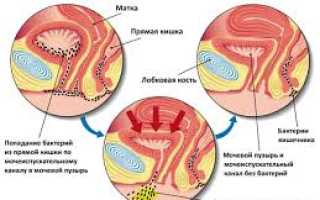 Почему молочница и цистит связаны?