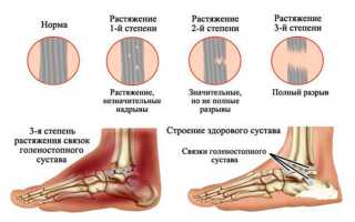 Что делать при разрыве связок голеностопного сустава — первая помощь и дальнейшее лечение