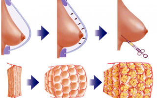 Липофилинг груди: процедура по увеличению молочных желез