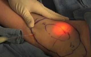 Лазерное лечение гипергидроза