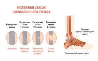 Первая помощь при растяжении связок — осложнения после травмы