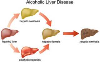 Понятие, симптомы и схема лечения алкогольного гепатита