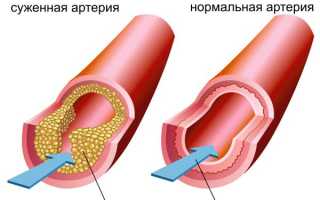 Последствия распития алкоголя при атеросклерозе