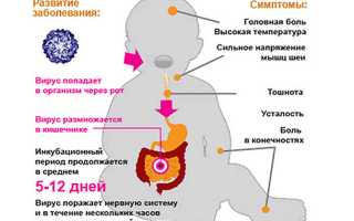 Симптомы и классификация полиомиелита