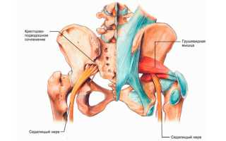 Синдром грушевидной мышцы: симптомы и лечение