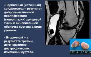 Что такое синовиальный хондроматоз коленного сустава — осложнения заболевания без лечения