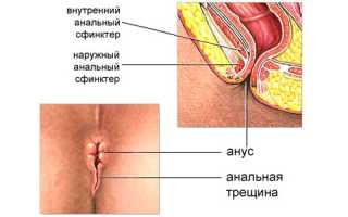 Как выполняется иссечение анальной трещины?