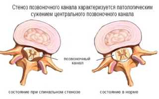 Что такое стеноз позвоночного канала и как он проявляется