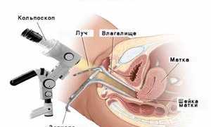 Подготовка и проведение кольпоскопии шейки матки