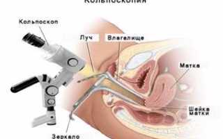 Подготовка и проведение кольпоскопии шейки матки