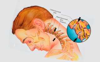 Боли в шее при повороте головы — причины и методы лечения