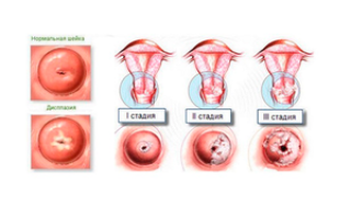 Особенности дисплазии шейки матки 3 степени