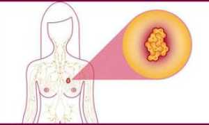 Аденоз молочной железы: симптомы и признаки, лечение