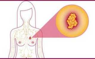 Аденоз молочной железы: симптомы и признаки, лечение