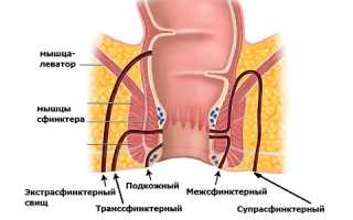 Чем опасен свищ прямой кишки