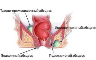 Парапроктит: насколько это опасно?