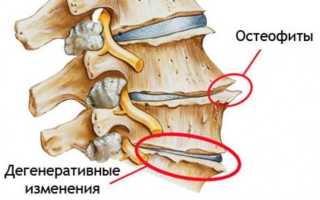 Что нельзя делать после операции по замене тазобедренного сустава